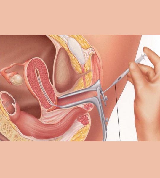 IUI