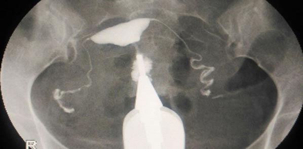 Hysterosalpingogram, HSG
